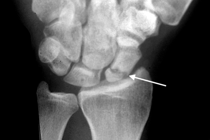 SCAPHOID NONUNION | Hand Surgery Resource